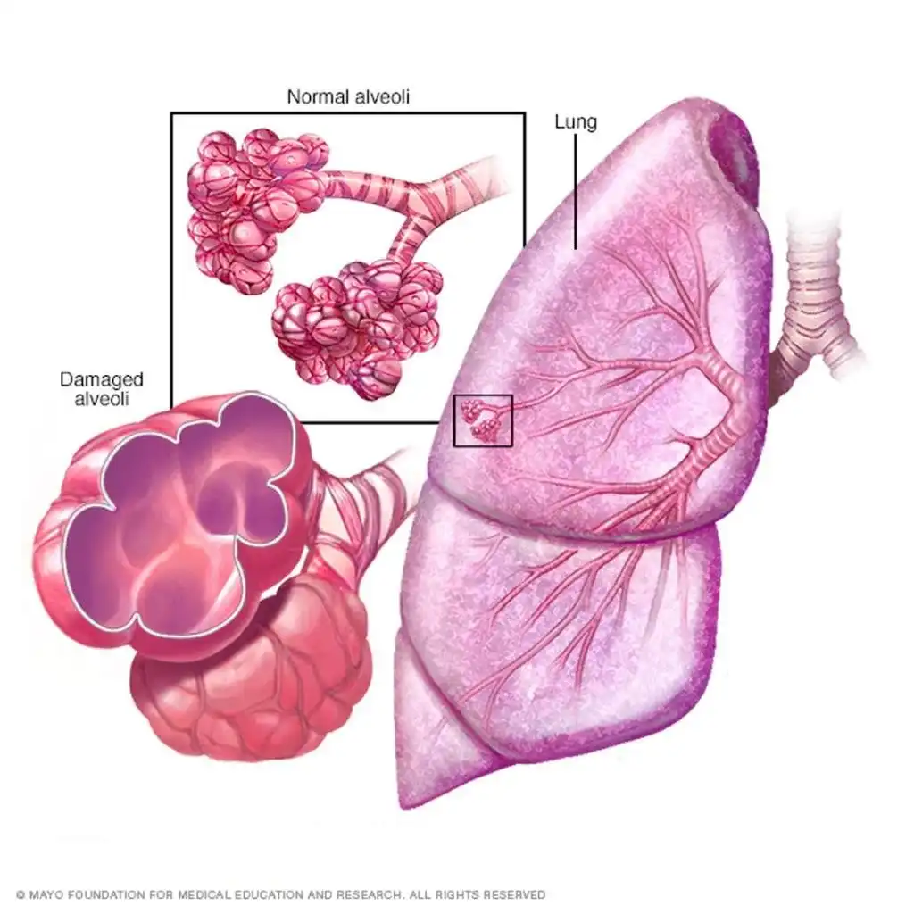آمفیزم ریه