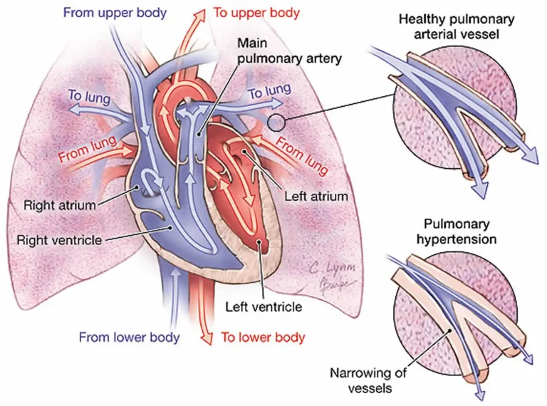 فشار خون ریوی